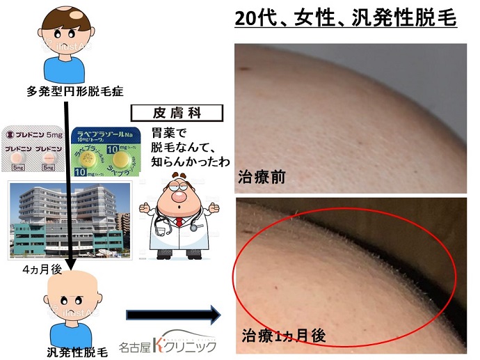 円形脱毛症　病院